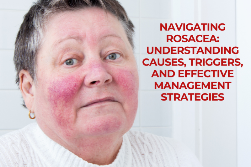 Navigating Rosacea: Understanding Causes, Triggers, and Effective Management Strategies